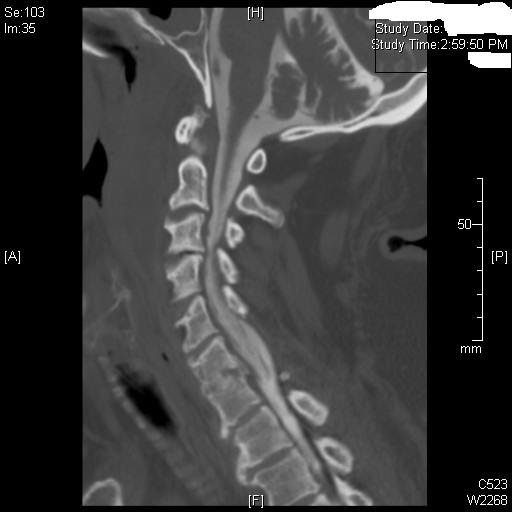 CT Pathology Blog Cervical disc bulge